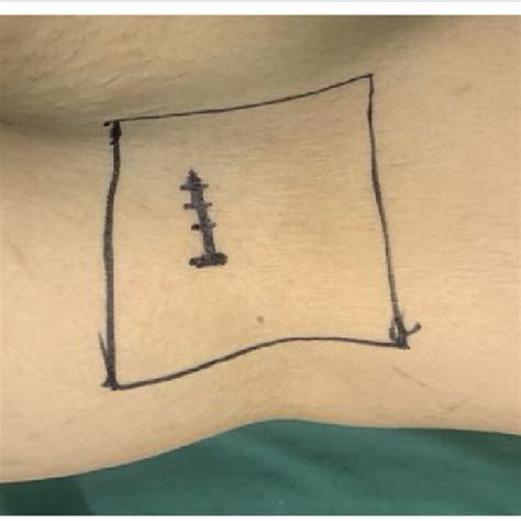 A Transverse Incision Was Marked On The Skin Before The Oblique Lateral