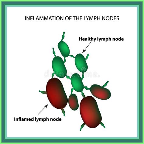 Inflammation Of The Lymph Nodes Infographics Vector Illustration On