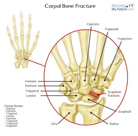 Carpal Ir Carpal Bones Para Carpal Bone Fractures Over Of Involve The