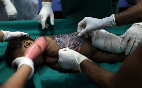 The best thing would be not to get one at all, but that doesn't always work out. Brazilian doctors use fish skin to treat burn victims ...