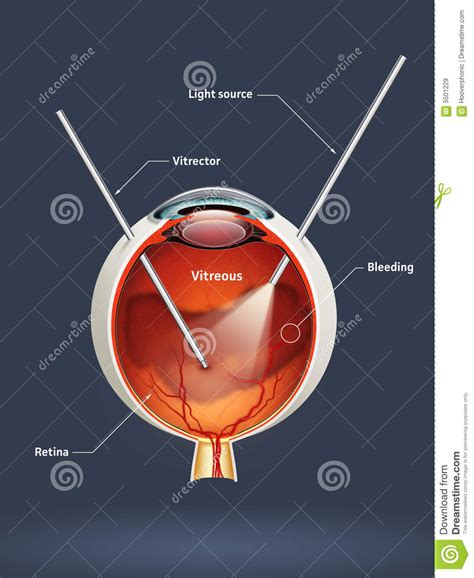 Retinal Detachment Vector Illustration Diagram Anatomical Scheme