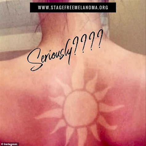 Sunburn Tattoo Trend Is Going Viral Online For The Summer Daily Mail