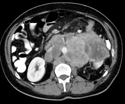 Lymphoma With Bulky Abdominal Nodes Stomach Case Studies Ctisus Ct