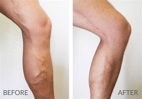 How Do I Distinguish Varicose Veins From Other Conditions