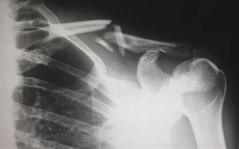 Video Treating Clavicle Or Collarbone Fractures Howard J Luks Md