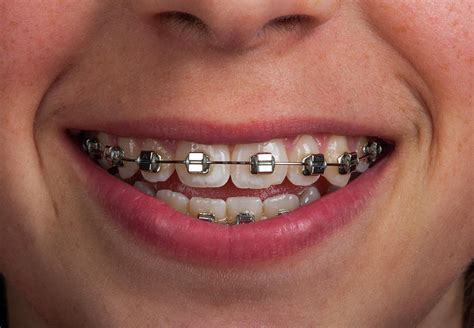 Fixed Orthodontic Braces Photograph By Pascal Goetgheluck Science Photo Library Pixels