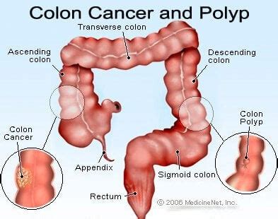 Difference between (:) colon vs semicolon (;)! Colon Polyps and Diverticulitis Differences & Relationship