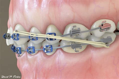 Treatment Auxillaries Elastics Rubber Bands Forbes Orthodontics