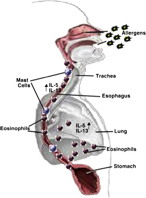 Mechanism Of Eosinophilic Esophagitis Immunology And Allergy Clinics