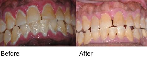 Scaling And Root Planing Periodontal Procedures