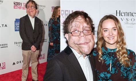 Adam Pearson Health Actor Opens Up About His Neurofibromatosis Type 1