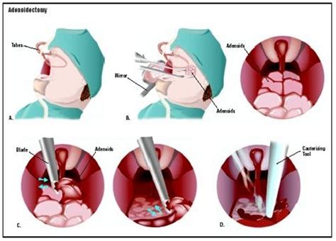 Adenoid Problems The Risks Involved With Adenoidectomy
