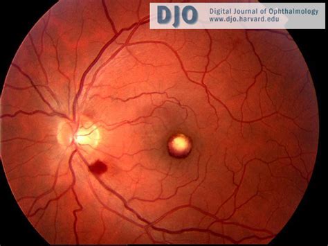 Djo Digital Journal Of Ophthalmology