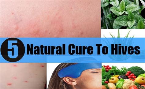 5 Effective Natural Cures For Hives Natural Home Remedies And Supplements