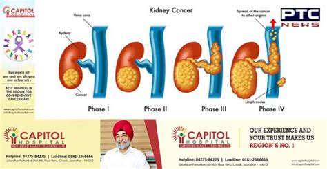 Understanding Kidney Cancer Common Types And Symptoms