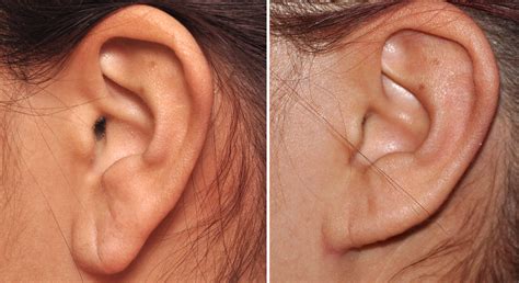 Female Earlobe Reduction Resuolt Left Side Dr Barry Eppley Indianapolis
