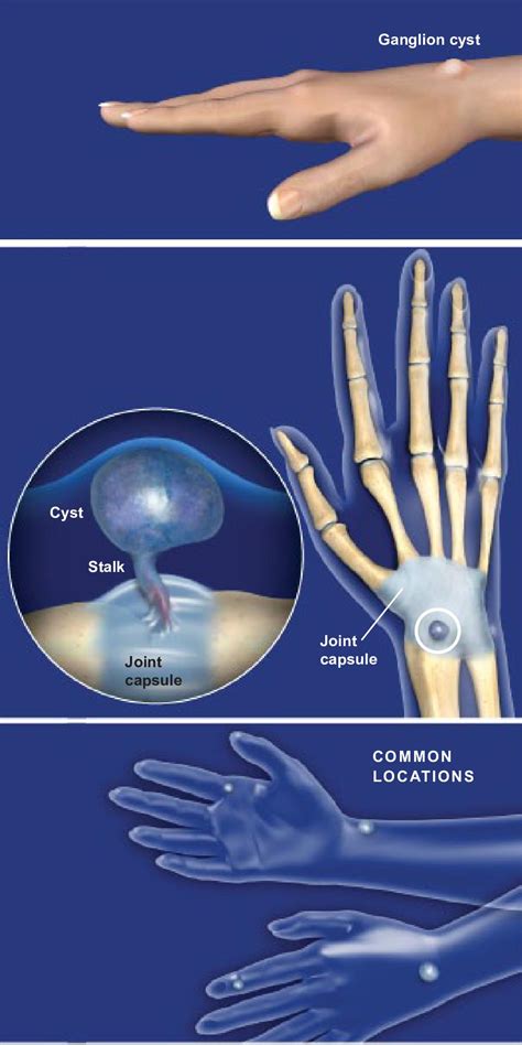 How Fast Do Ganglion Cysts Grow They Tend To Grow Quickly And Are