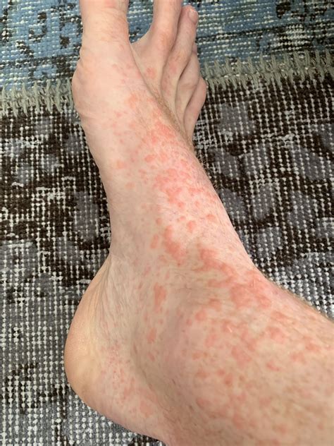 Rash On Legs And Arms Mostly Concentrated On My Feet Have Recently
