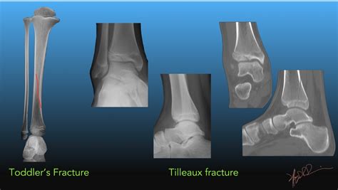Pediatric Tibial Fractures Uw Emergency Radiology