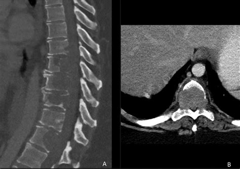 Initial Ct Of The Spine A Sagittal And B Axial Images Of The