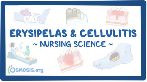 Erysipelas Vs Cellulitis Vs Impetigo