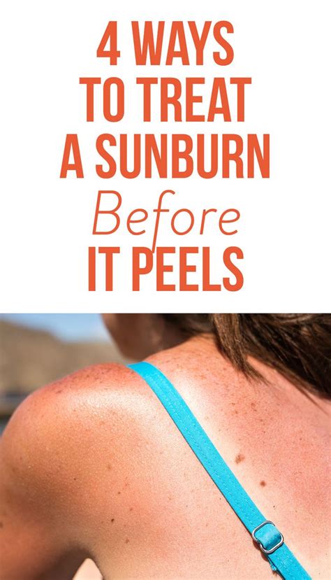Ways To Treat A Sunburn Before It Peels So You Can Keep Your Tan