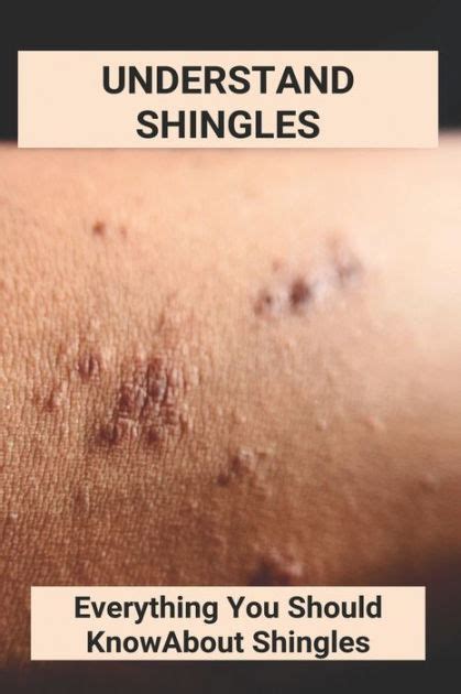 Understand Shingles Everything You Should Know About Shingles