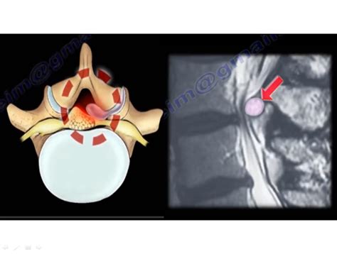 Synovial Cyst Of The Spine —