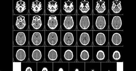 tomografia de crânio como é feita e para que serve médico responde