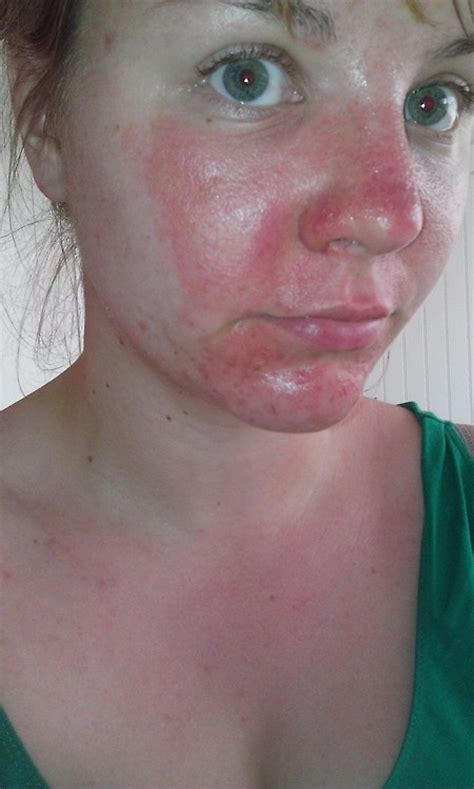 Effective And Lasting Healing For Facial Cellulitis Casestudy Types Of