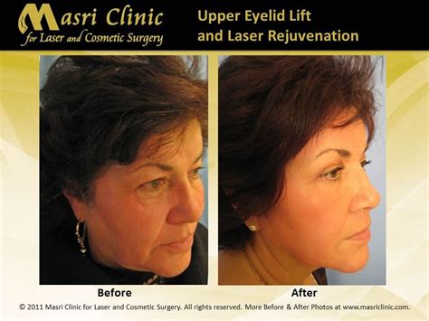After Upper And Lower Eyelid Surgery Blepharoplasty Skin Treatment