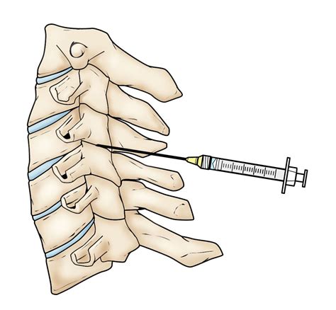 Spinal Facet Injections