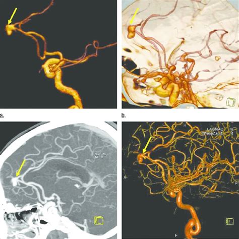 One Aneurysm In The Right Cavernous Segment Of Internal Carotid Artery