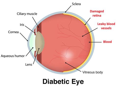 Diabetic Retinopathy Treatment The Vision Care Center Medical Eye Care
