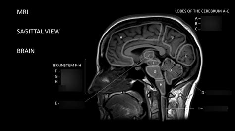 The Brain Imaging Sagittal View Diagram Quizlet