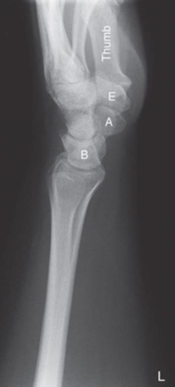 Lateral Wrist Radiograph Diagram Quizlet