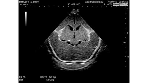 Ultrasound Neonatal Head Phantom Normal