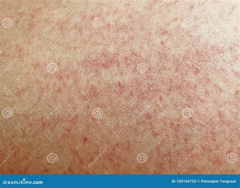 Rash On Sensitive Skin Stock Image Image Of Body Acne 103166733