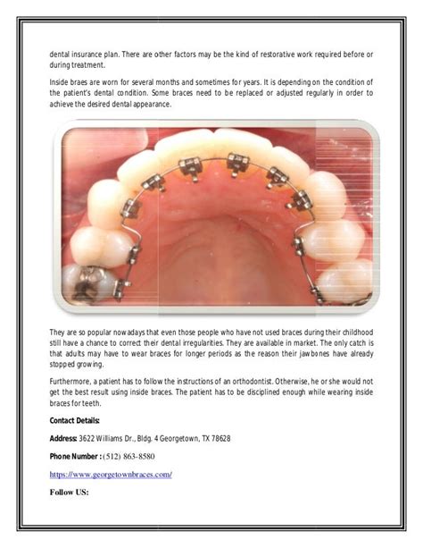 Inside Braces