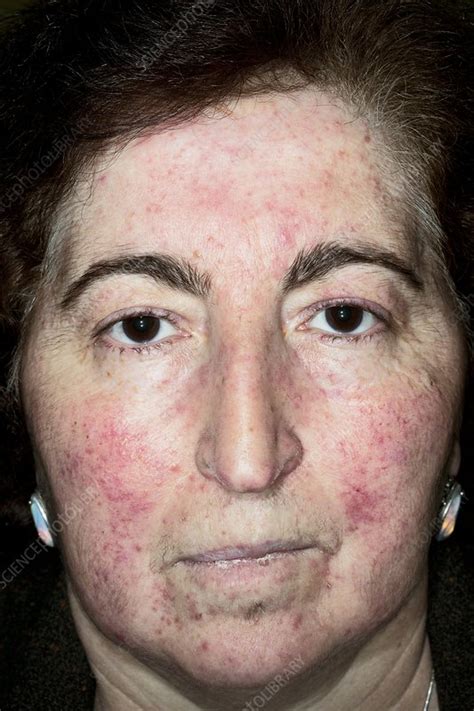 Acne Rosacea On The Face Stock Image C0119516 Science Photo Library