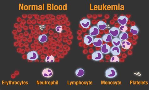 Lymphatic And Blood Cancer Facts And Symptoms Uhc Oncology