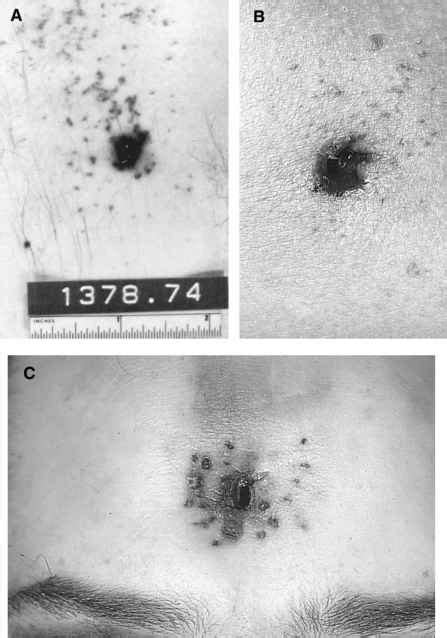 Stippling Powder Tattooing And Pseudo Powder Tattooing Contact Wounds