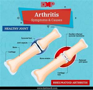 Arthritis Its Different Types Blog By Datt Mediproducts