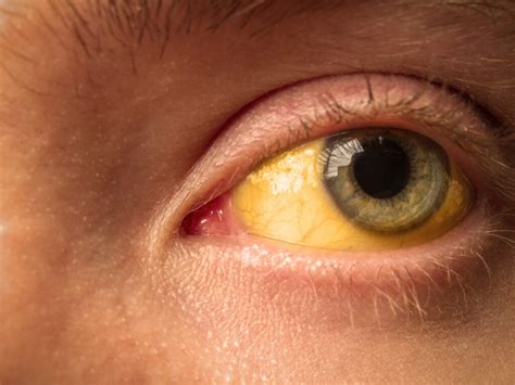 Yellow Eyes Common Causes And When To See A Doctor