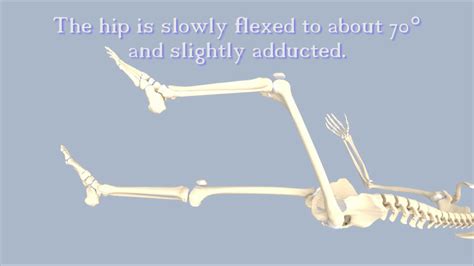 Anterior Vs Posterior Hip Dislocation