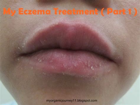 Eczema On Lip Pictures Photos