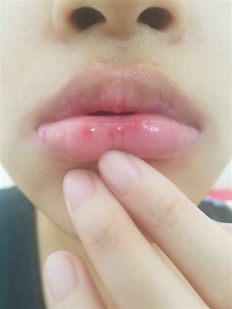 why do i have a rash on my lips