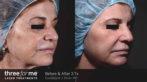Wrinkle And Fine Line Removal Treatments Lindon Medical Lasers