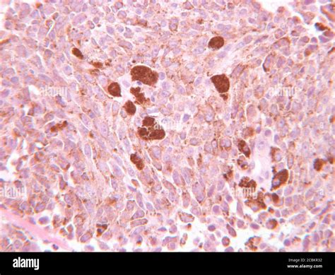 Melanoma Maligno Fotografías E Imágenes De Alta Resolución Alamy