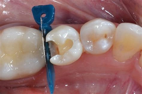 What happens if you wait too long to get a root canal? How are cavity fillings done between teeth? - Quora